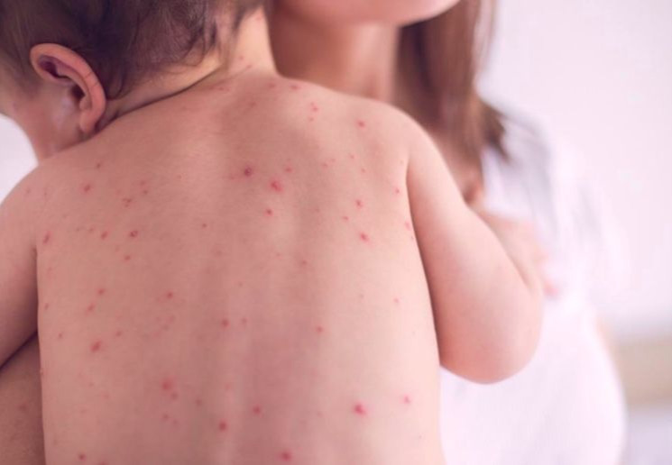 Улаанбурхан гэж ямар өвчин вэ?