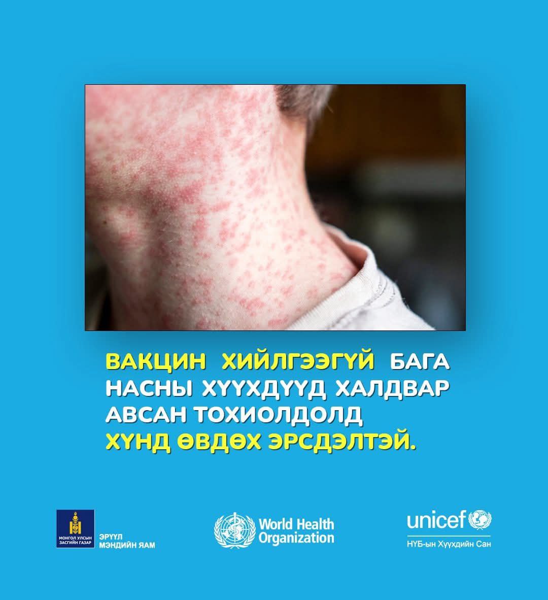 Улаанбурхан өвчин нь халдварлалт өндөртэй ч вакцинаар сэргийлэгдэх боломжтой