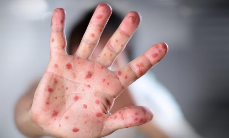 Улаанбурхан өвчний нөхцөл байдлын мэдээлэл