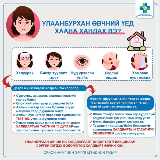 Улаанбурхан өвчний шинж тэмдэг Улаанбурхан өвчний шинж тэмдэг