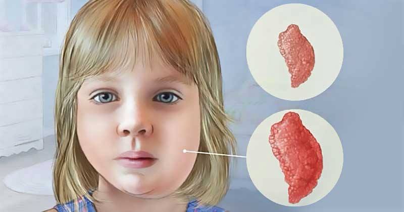 Гахай хавдраас сэргийлье